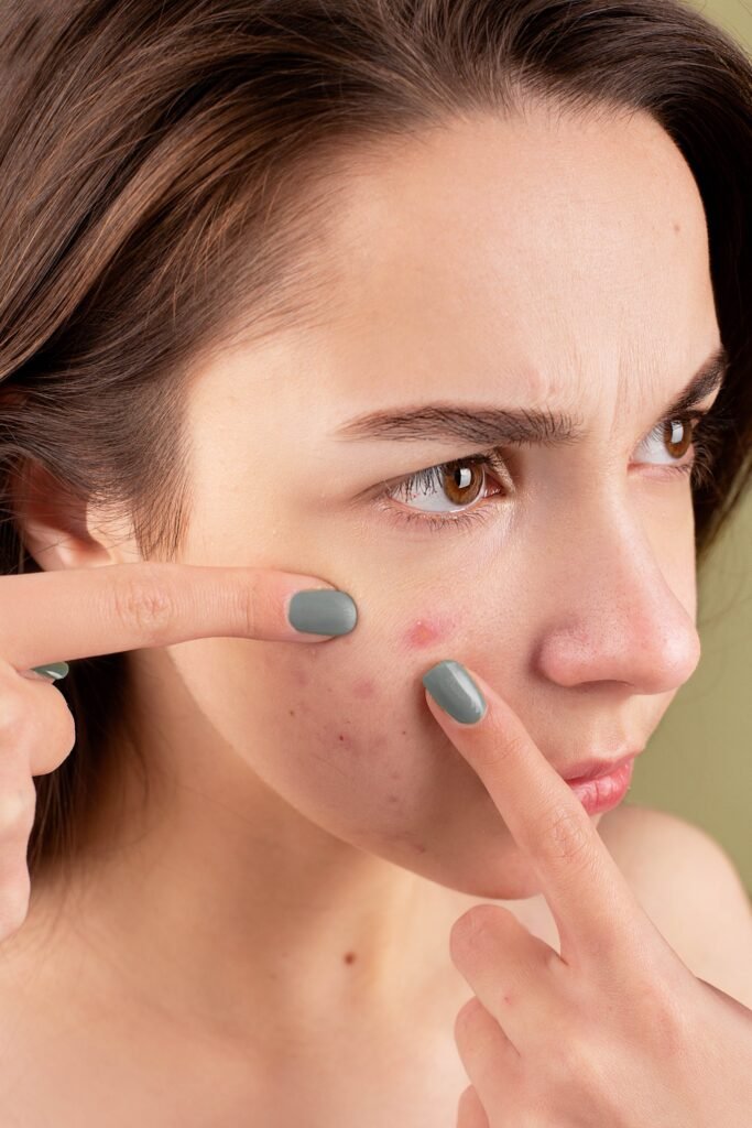 Acne-How To Choose The Best Skin Care